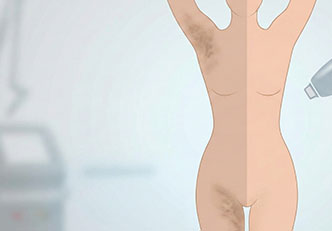 Koltuk Altı ve Kasık Kararmasi: Nedenler ve Kalıcı Çözümler