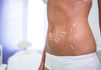Lipoliz ile Göbek Eritme (Abdominal Fat Reduction)