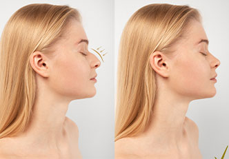 Burun Dolgusu (Non-Surgical Rhinoplasty)